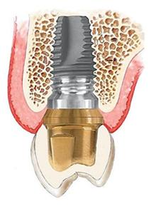 implant dentaire gouronne