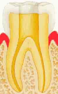 Dévitalisation dent