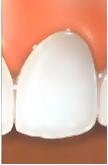 soins dentaires facettes
