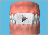 tarifs implants dentaires