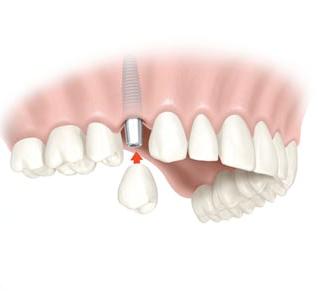 mise en place implant dentaire